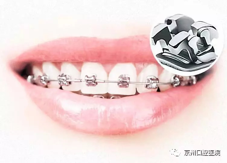 双翼金属托槽是我们最传统的矫治器,托槽和弓丝都固定在牙齿外侧,一露